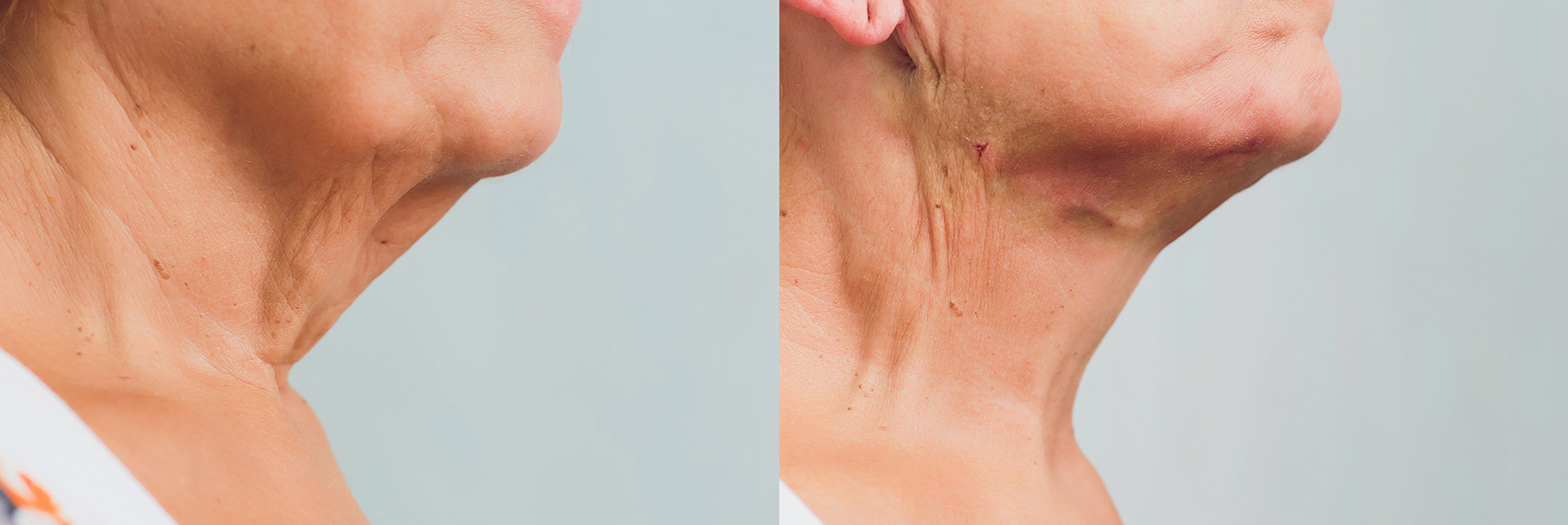 picture displays a before picture of acne scarred skin alongside an after picture, after receiving skin resurfacing treatment