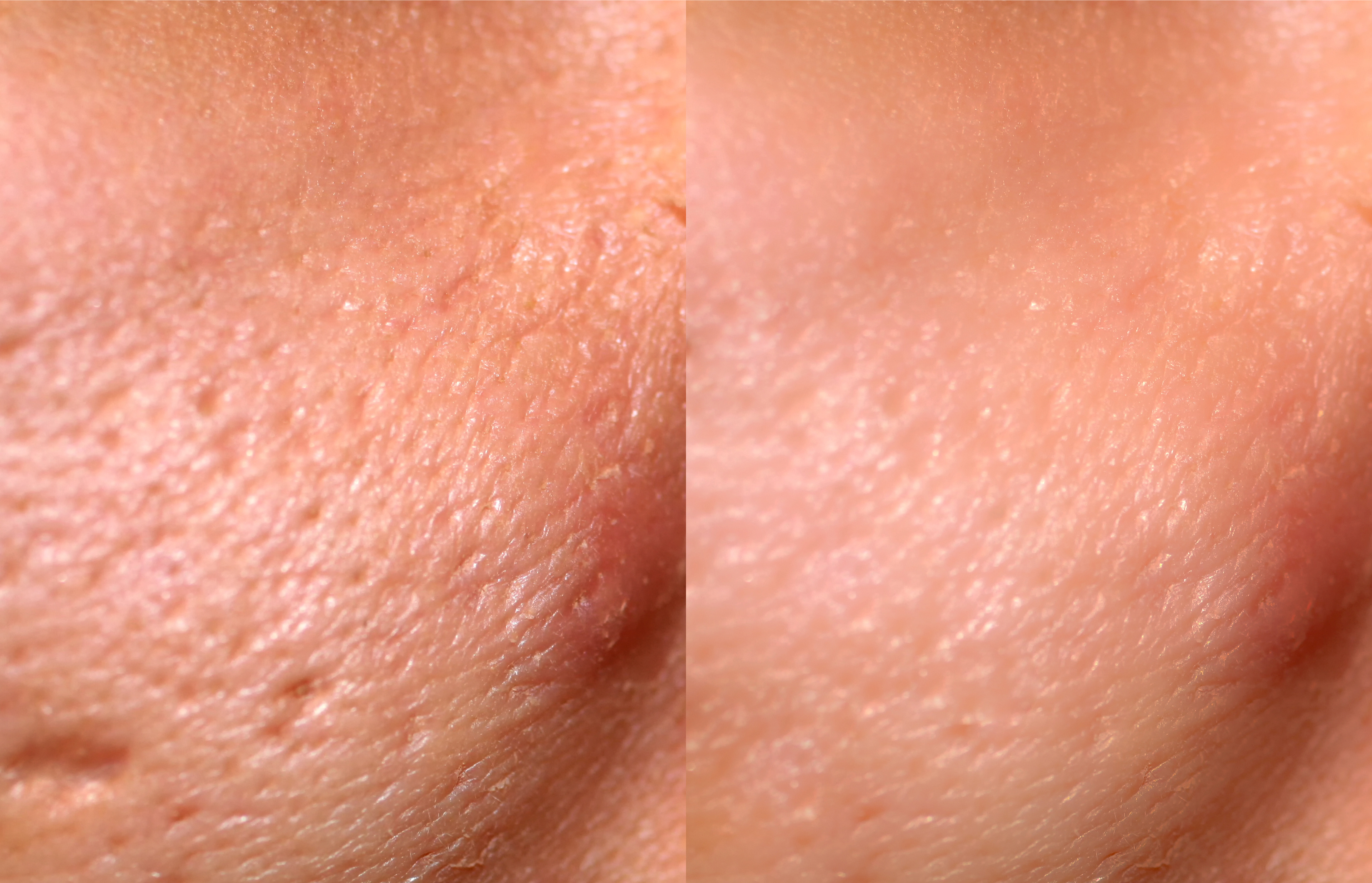 picture displays a before picture of acne scarred skin alongside an after picture, after receiving skin resurfacing treatment