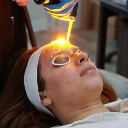 picture displays a woman laying down with her eyes covered by protective eyewear receiving laser resurfacing treatment for acne