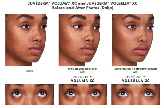 Before and after pictures of Daija, a patient who received Juvederm to add volume to her checks and remove the hollows under her eyes.