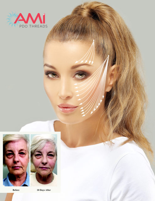a before and after picture set nested on a larger picture of a woman with white arrows on superimposed over her face depicting where threads would be inserted to achieve the maximum lift desired.