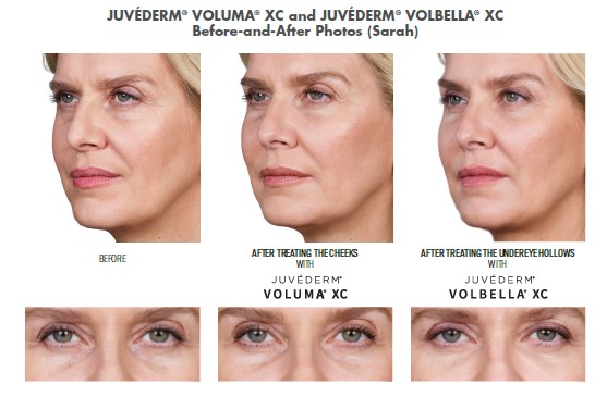 Before and after pictures of Sarah, a patient who received Juvederm to add volume to her checks and remove the hollows under her eyes.